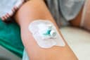 Krótka kaniula – czas na zmianę? Co mówią najnowsze zalecenia
